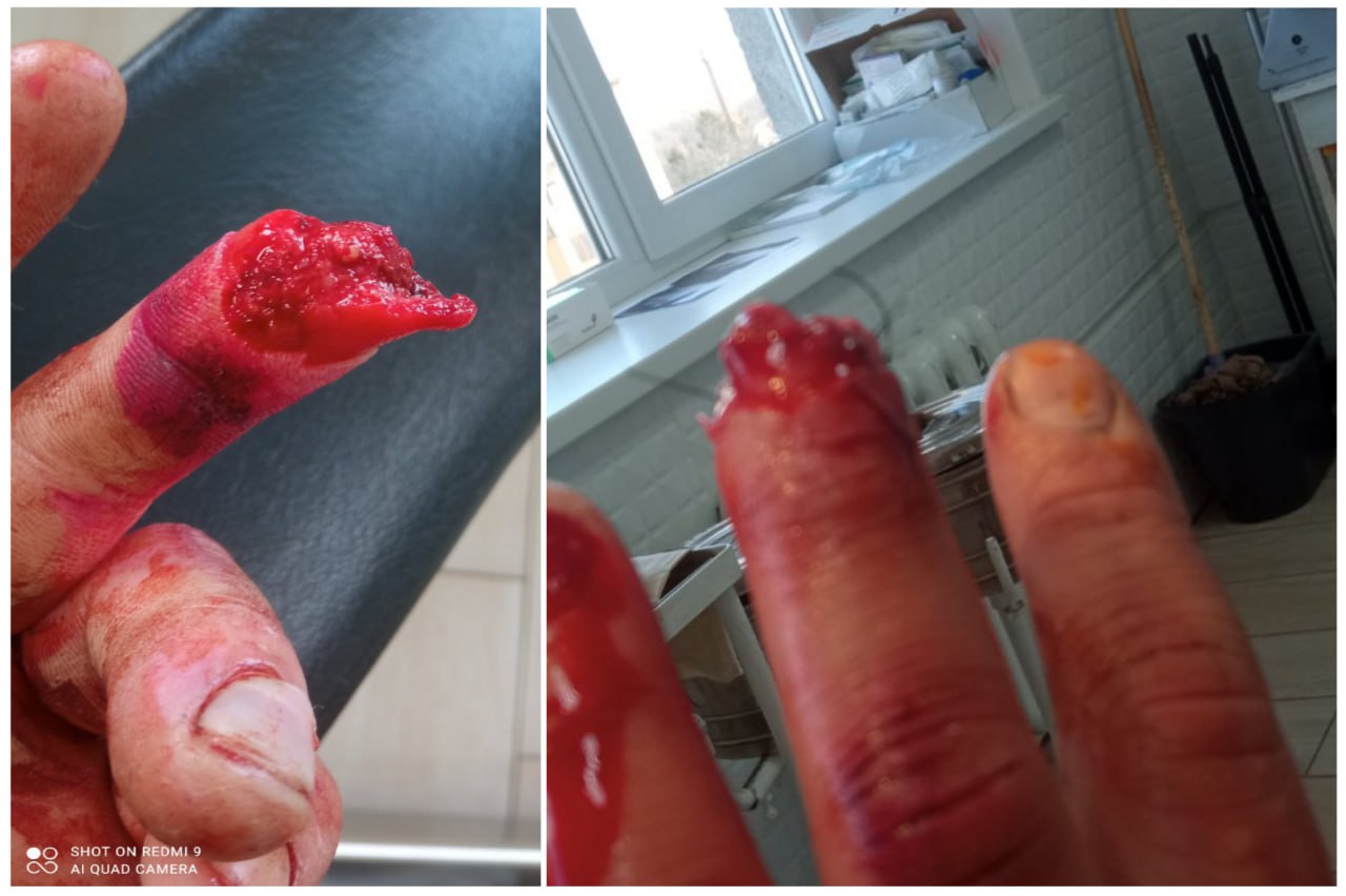 В Юрковцах рейдеры ПЦУ оторвали ломом палец у верующего УПЦ фото 1